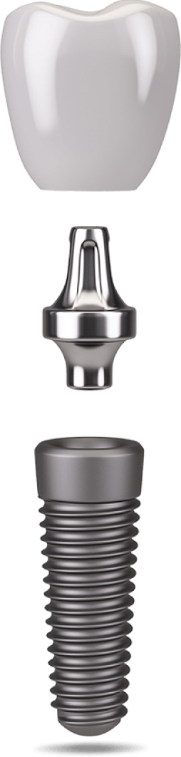 dental implant icon showing the three separate parts: crown, abutment, and post