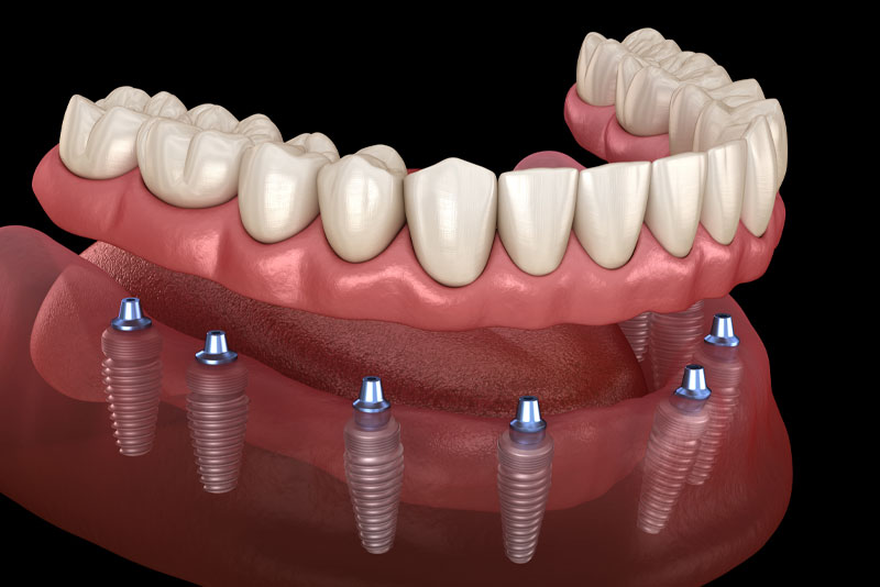 full mouth dental implants model