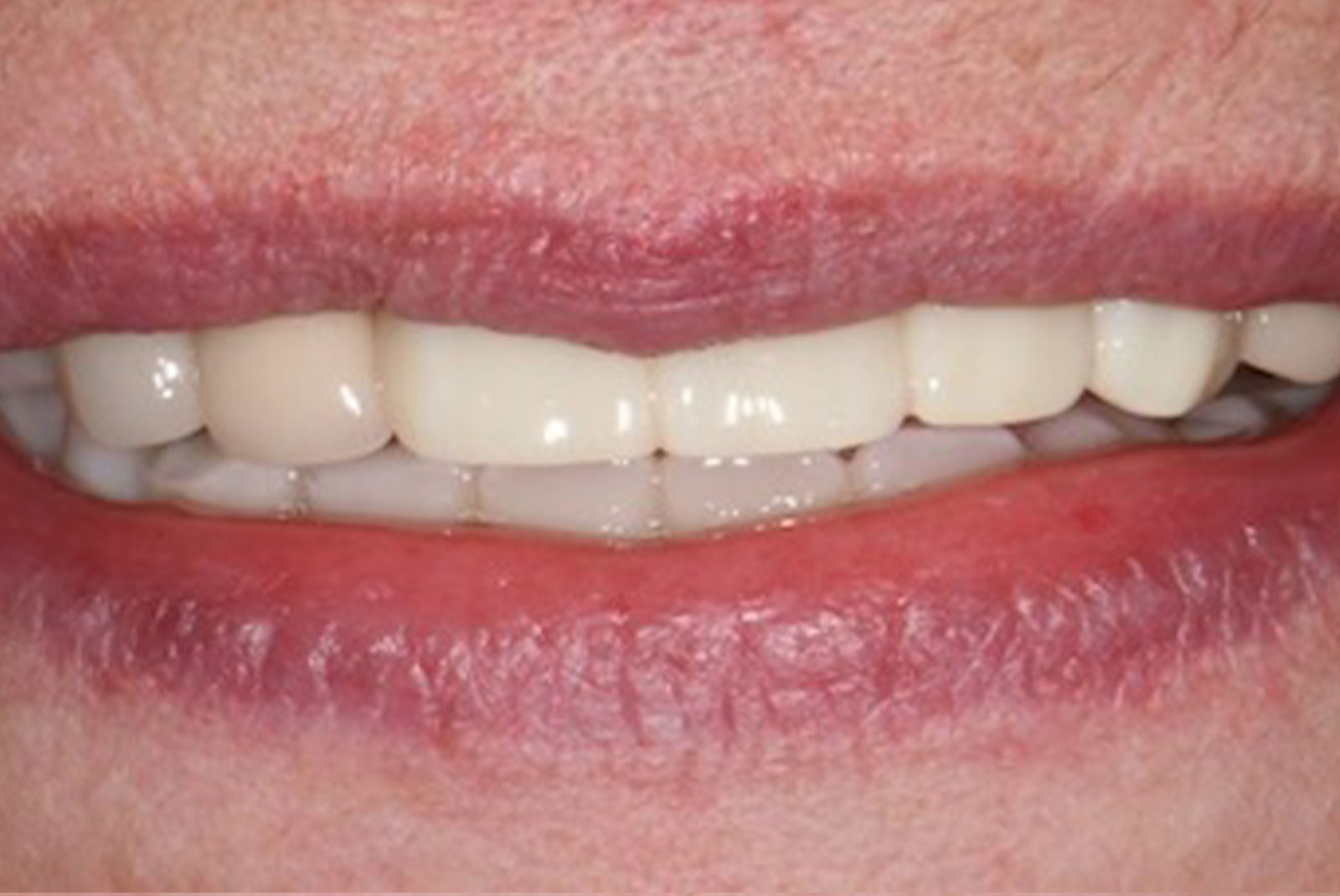 before and after close up of patient procedure results