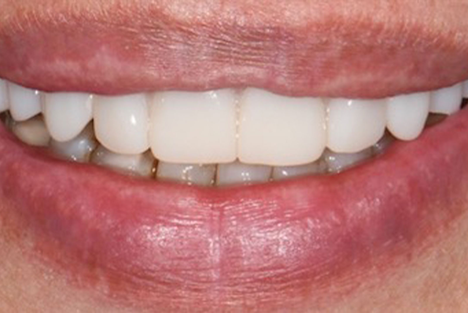 before and after close up of patient procedure results