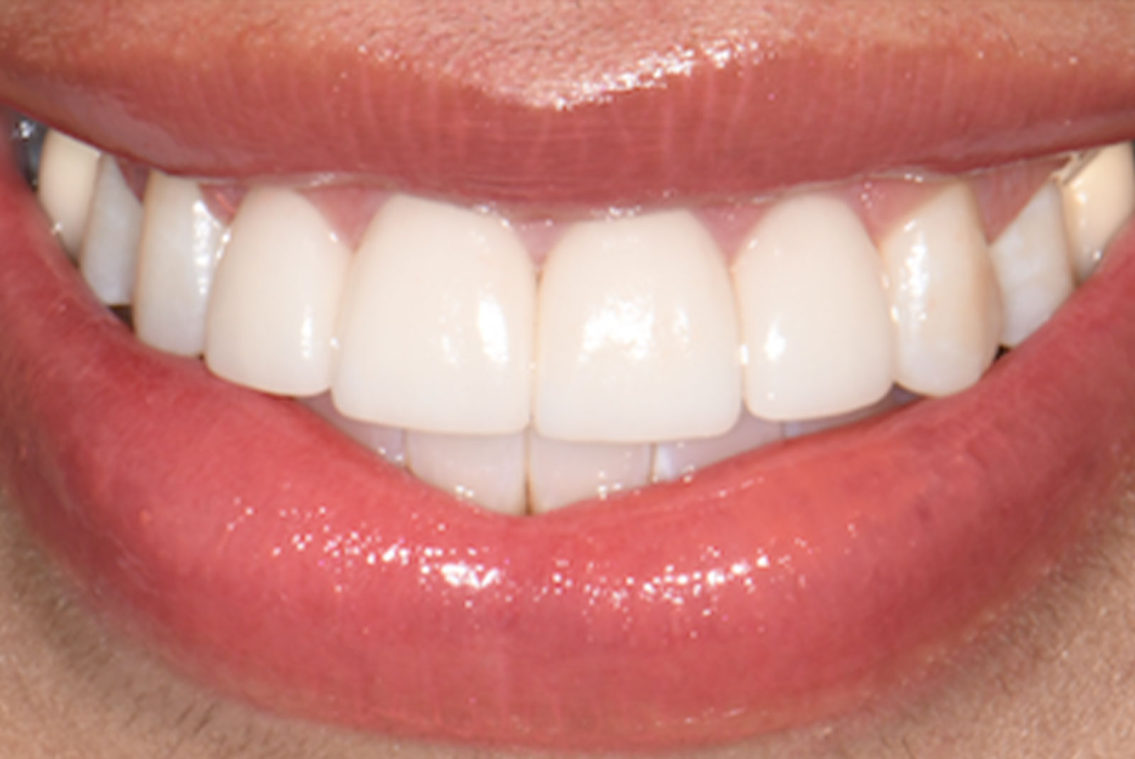 before and after close up of patient procedure results