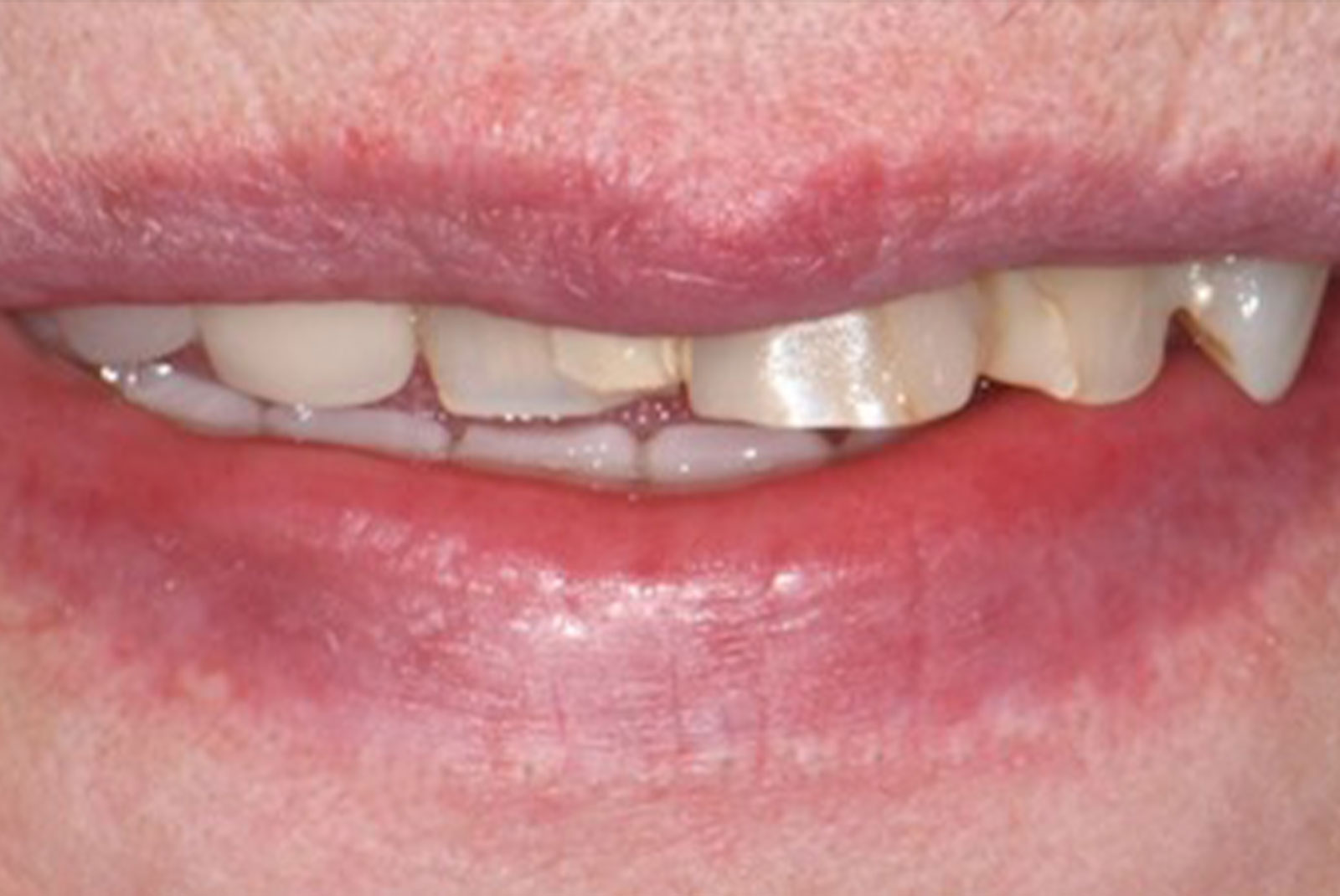 before and after close up of patient procedure results