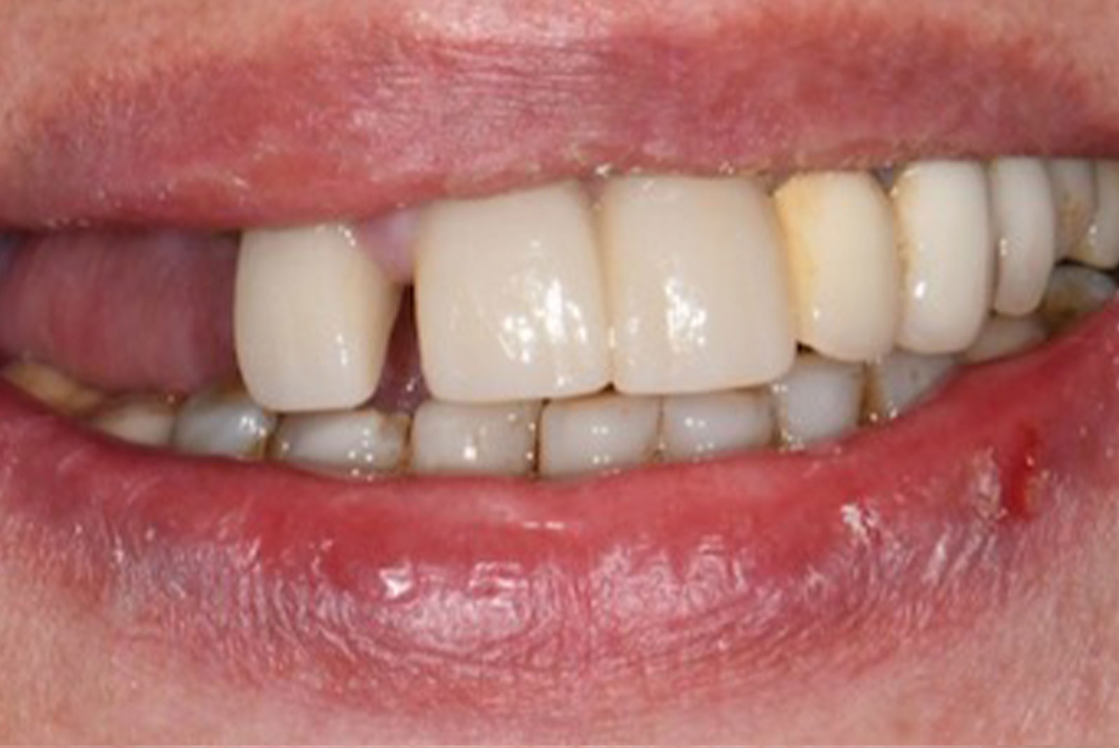 before and after close up of patient procedure results
