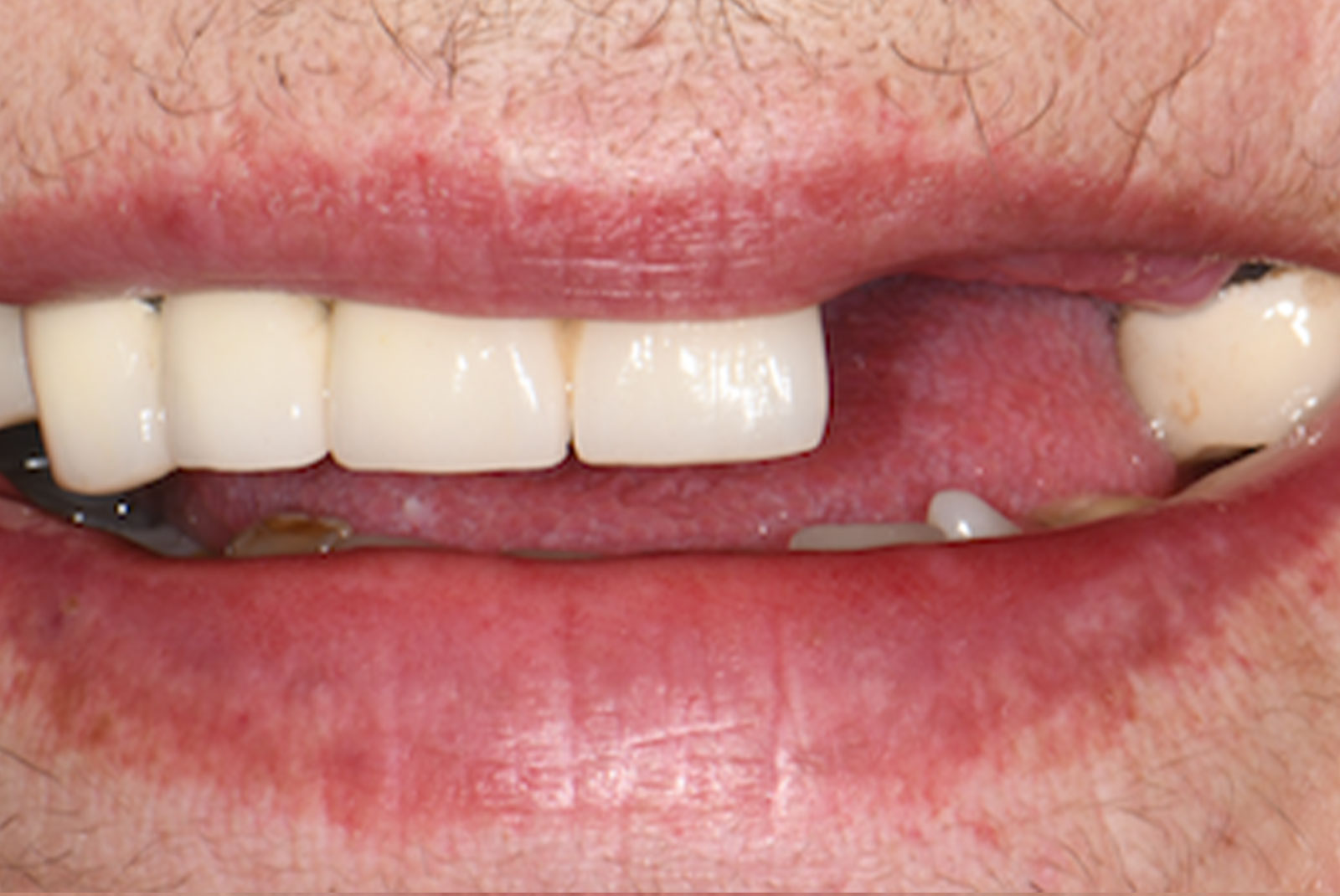 before and after close up of patient procedure results