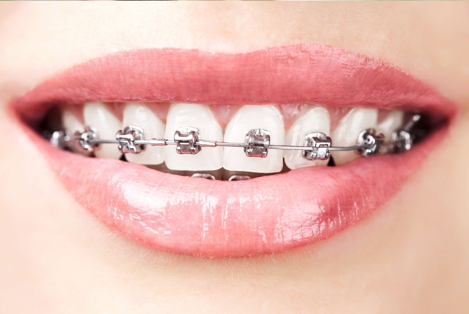 close up of braces