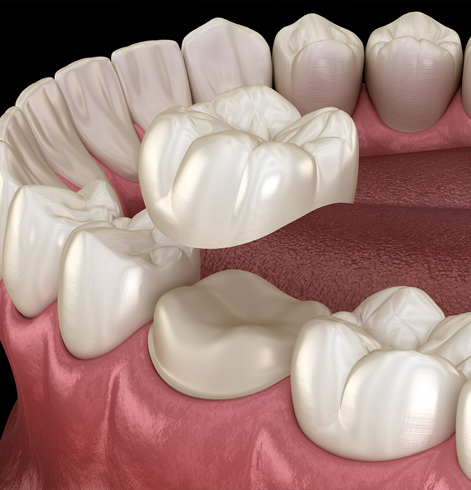 dental crown illustration
