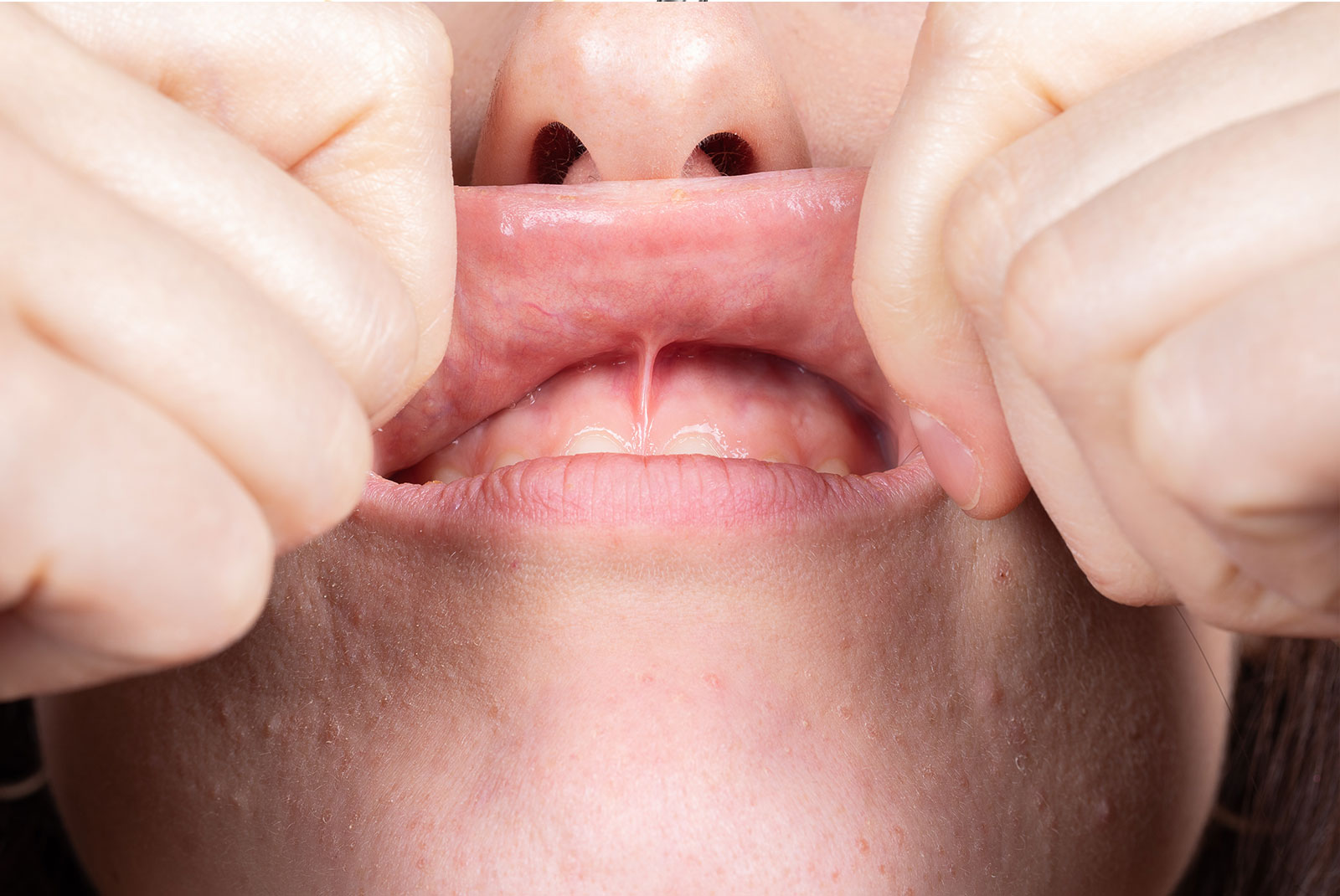 Frenectomy illustration