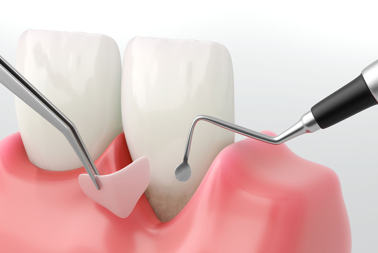 Gingival Graft illustration