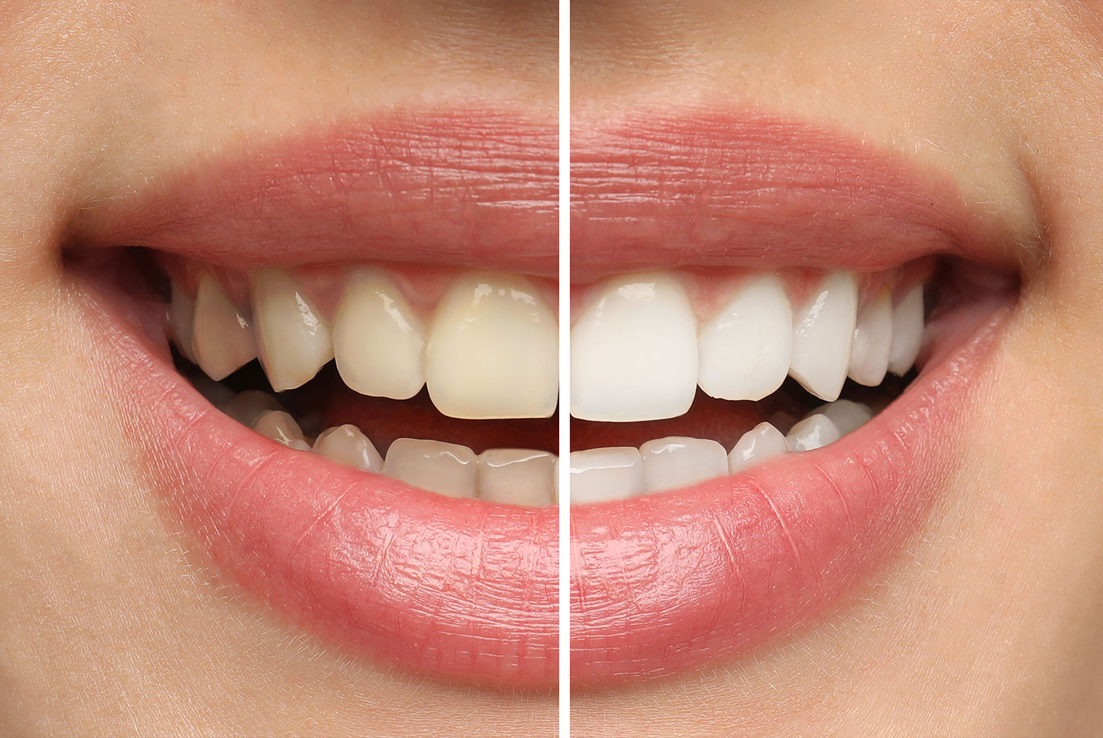 teeth whitening compare
