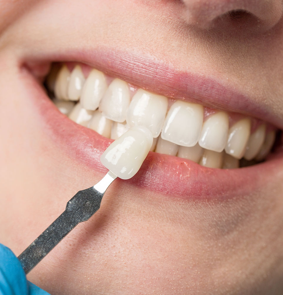 close up of veneer model